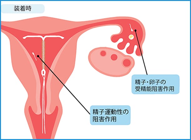 子宮内に装着された銅付加IUD図 子宮内に装着された銅付加IUD図