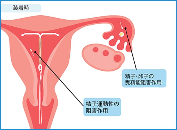 Iudによる避妊 避妊のススメ