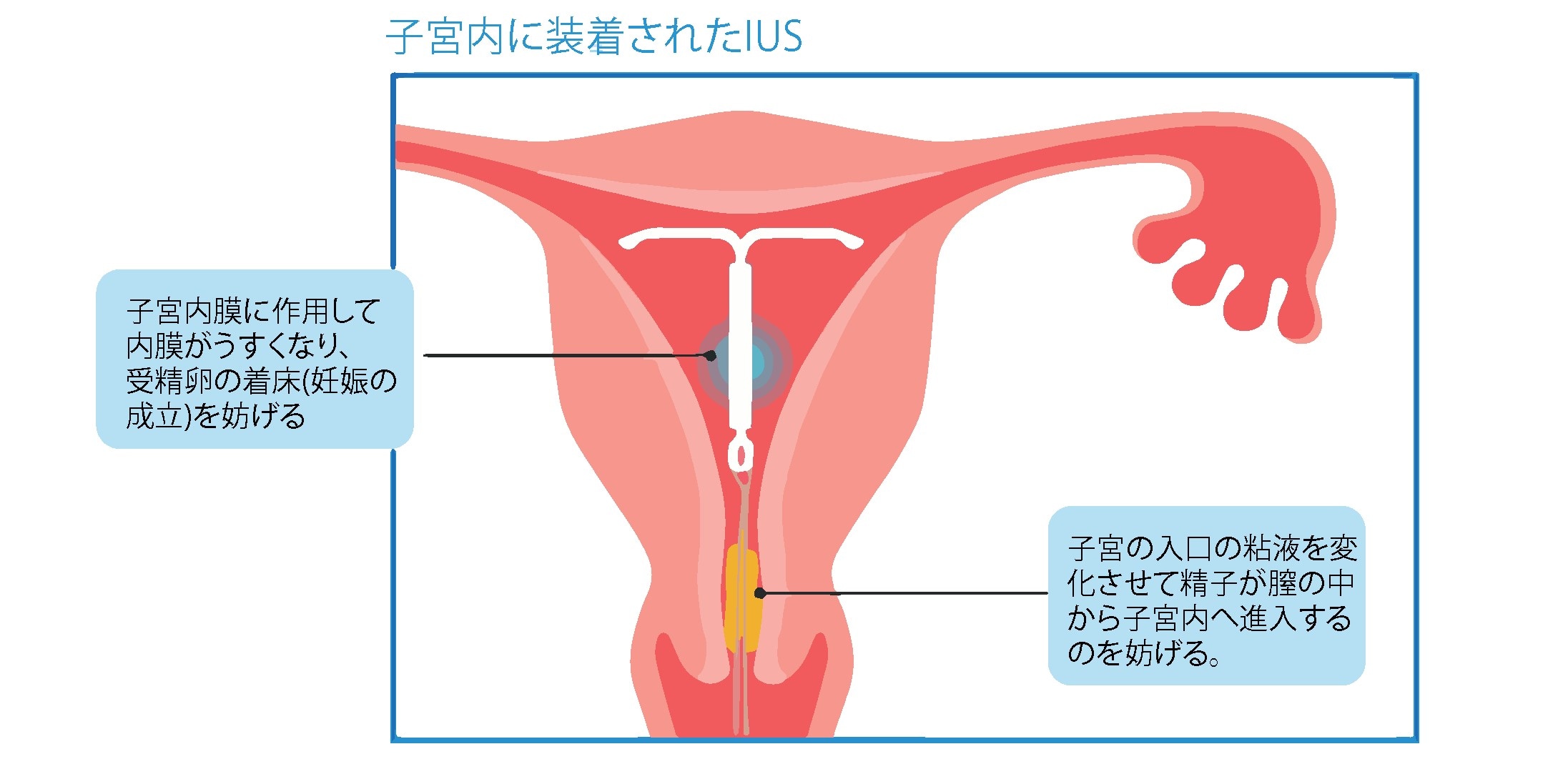 子宮内に装着されたIUS