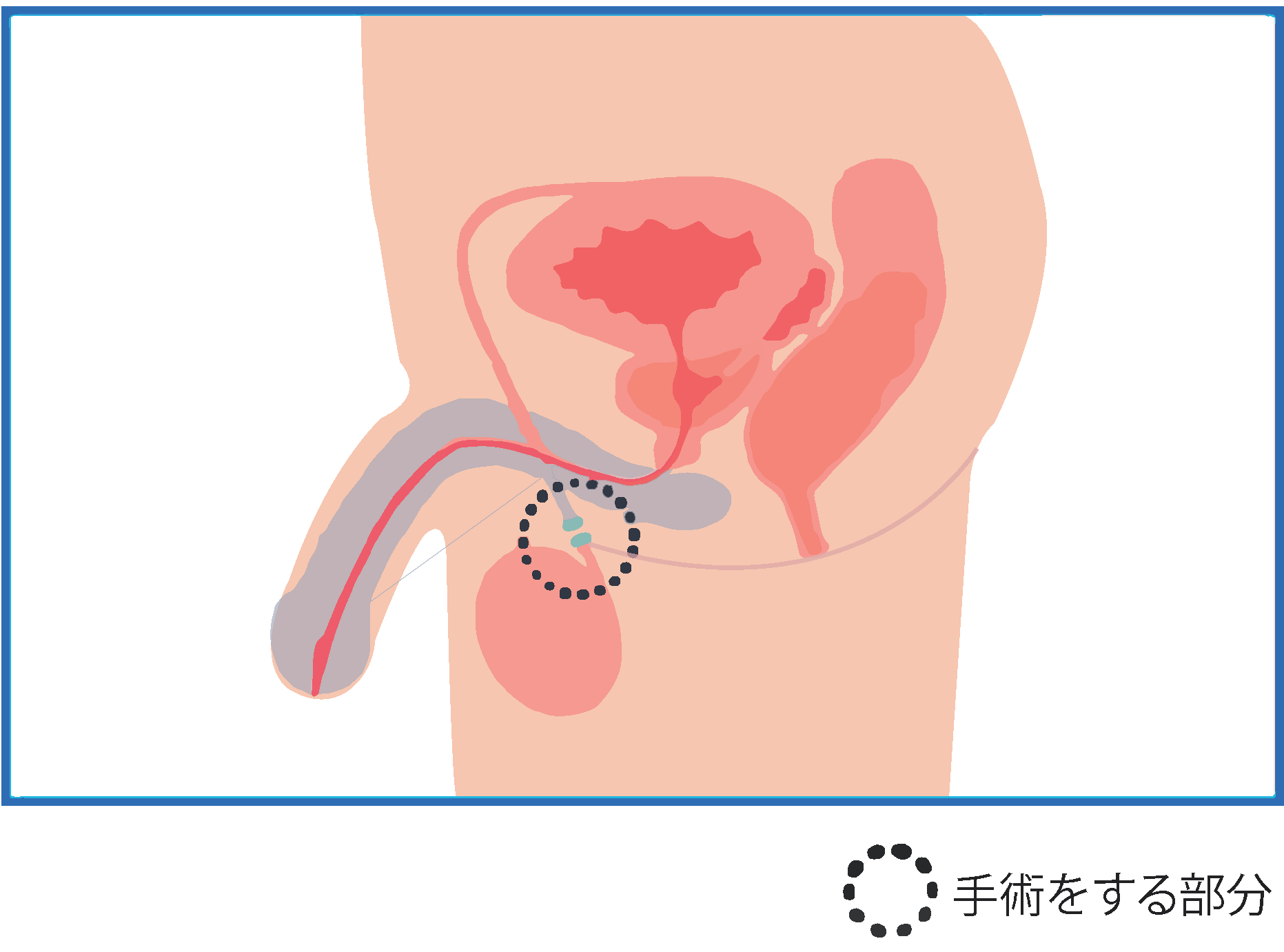 男性の避妊手術図