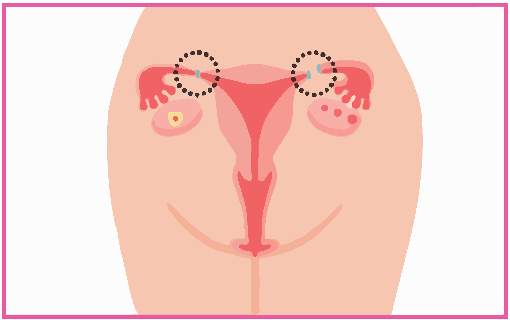 女性の避妊手術図